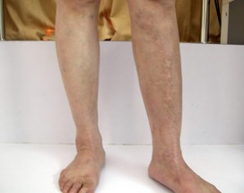 腿部初期白癜风.jpg